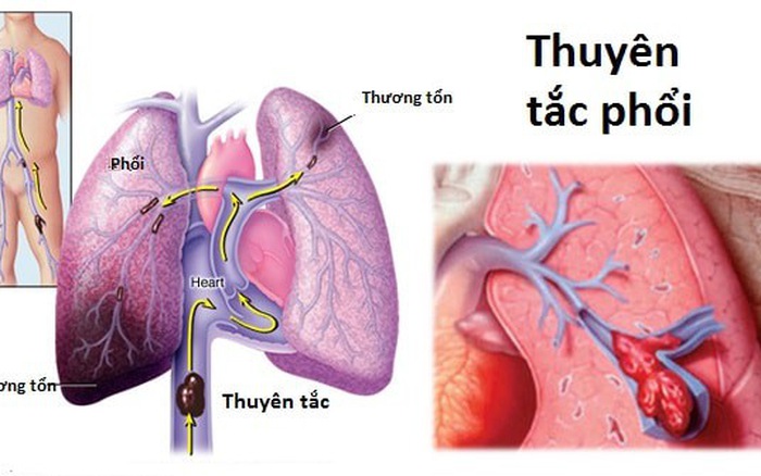 Thuyên tắc phổi - Hình ảnh minh họa